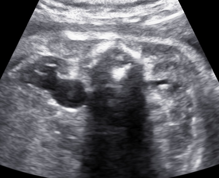 Fetal Hydronephrosis