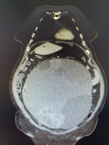 giant ovarian tumor ct