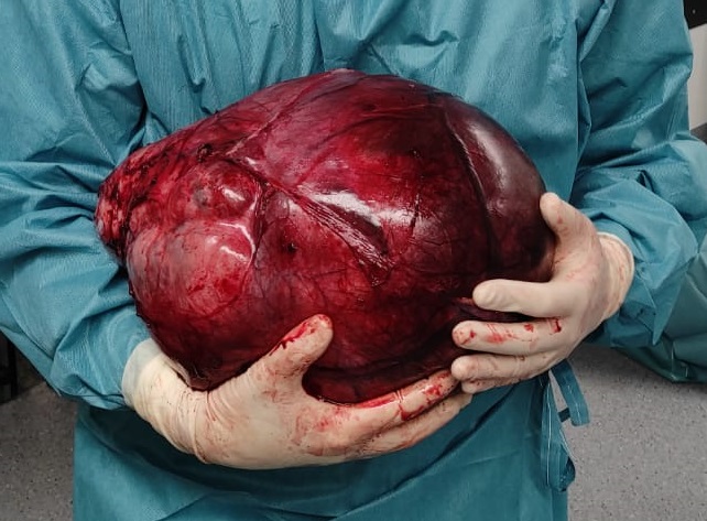 giant ovarian tumor surgery